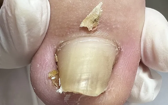 Видалення врослого нігтя в нашому центрі Видалення врослого нігтя Київ