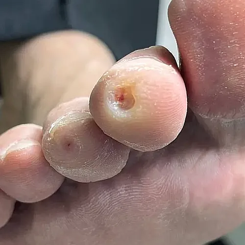 Calluses on toes after removal procedure Calluses on toes after treatment
