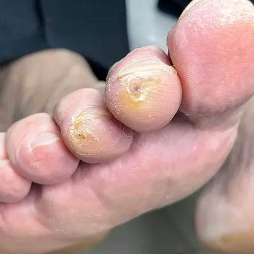 Calluses on toes before treatment Calluses on toes