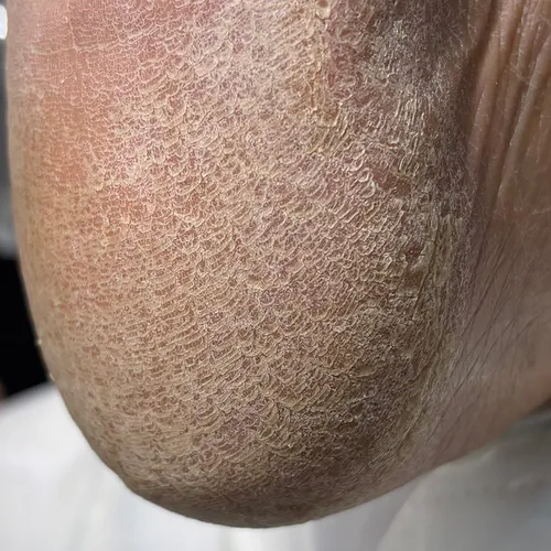 cracked heel picture