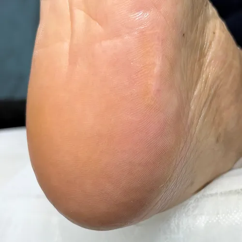 Cracked heel treatment