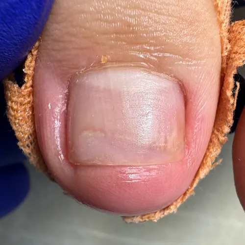 Nail separation: after treatment Onycholysis after treatment