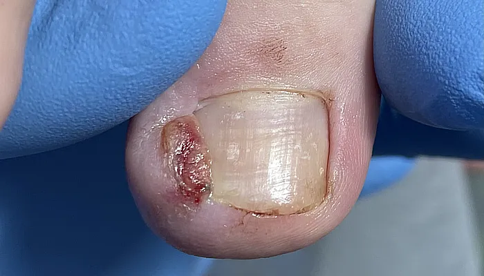 ingrown nail photo