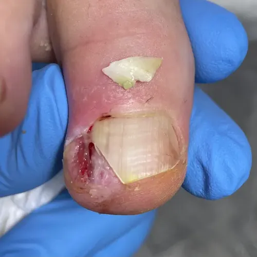 Ingrown toenail after removal procedure Ingrown toenail after treatment