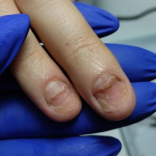 Nails after treatment Onychomycosis after treatment