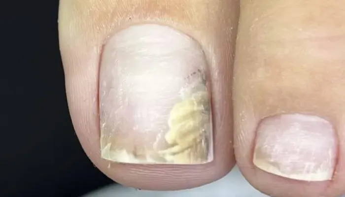 nail separation photo