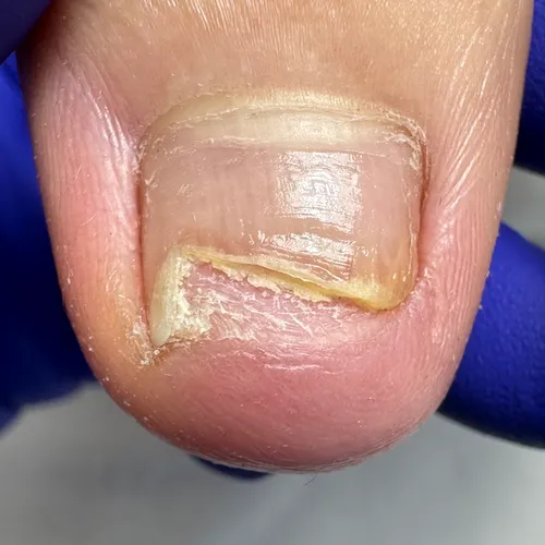 Nail separation: before treatment Onycholysis of toenail