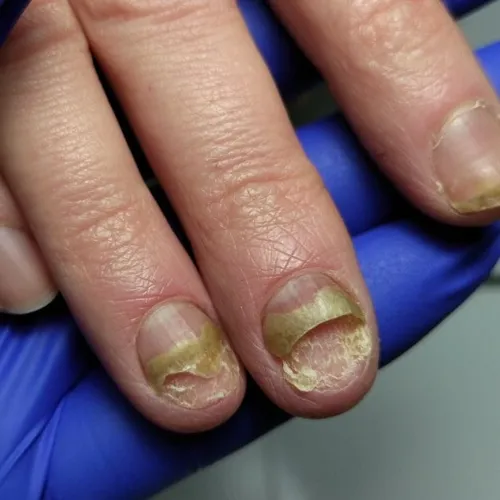 Nail fungus: before treatment Onychomycosis of toenails