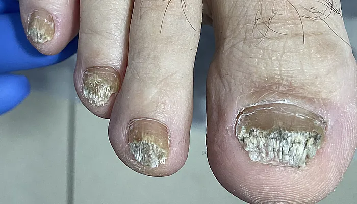 toenail fungus picture