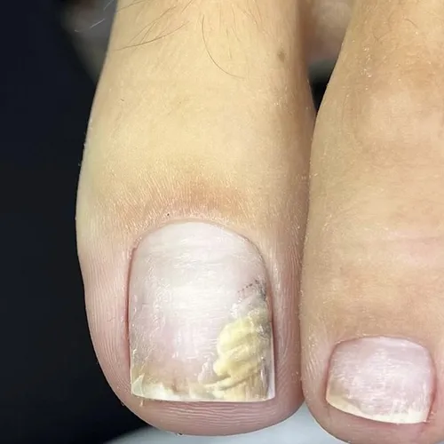 toenail separating from nail bed