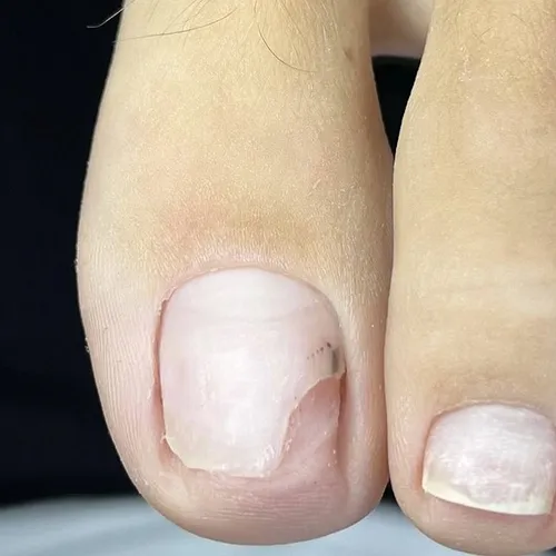 Toenail separation treatment