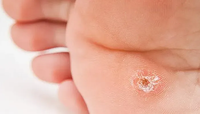 wart on foot image