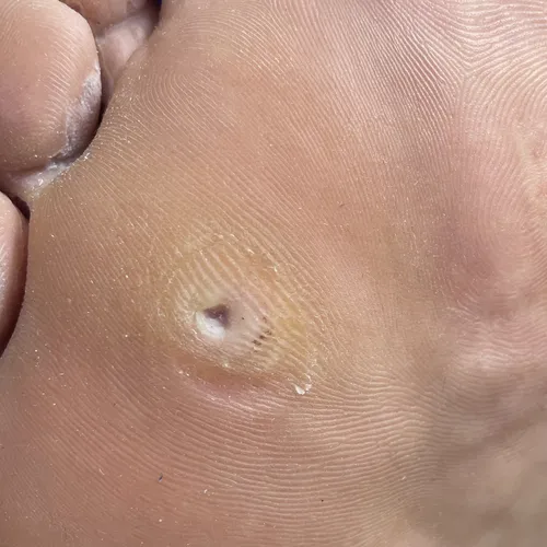 Callus on foot treatment