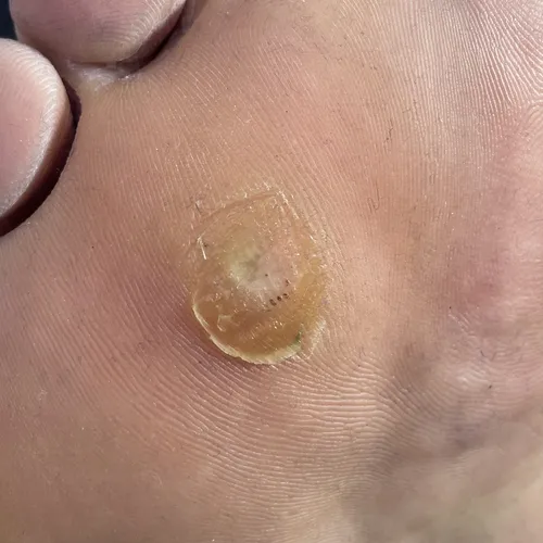 Callus on foot