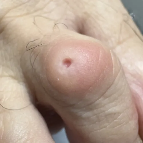 Corn on finger treatment