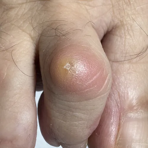 corn on finger