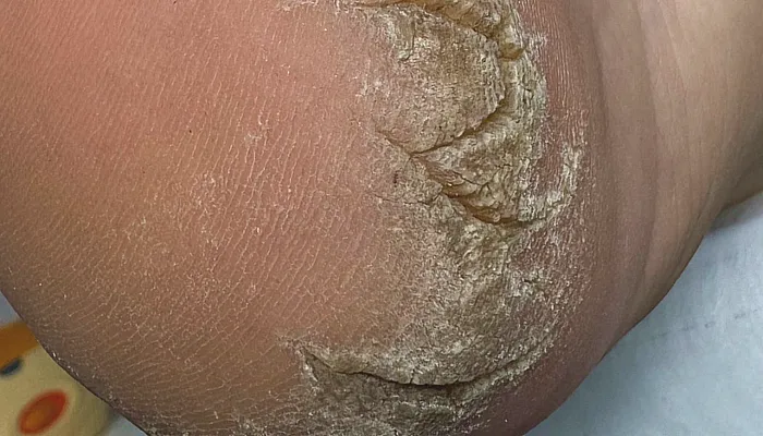 Cracked heels and foot fissures treatment Kyiv cracked heels treatment