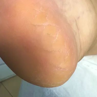 foot skin fissures treatment