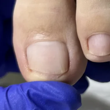 Fungal nail infection treatment
