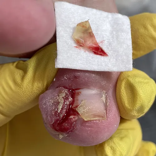 ingrown nail infection
