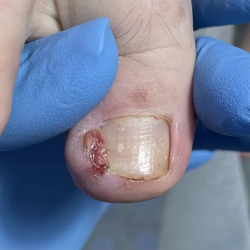 Ingrown nail on finger