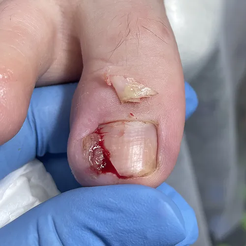 ingrown nail removal