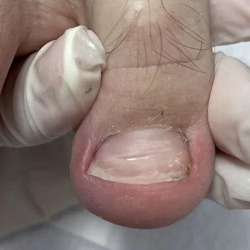 Ingrown nail treatment