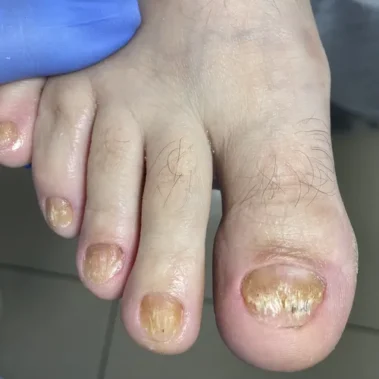 nail fungus treatment
