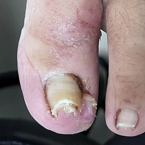 onychocryptosis toenail