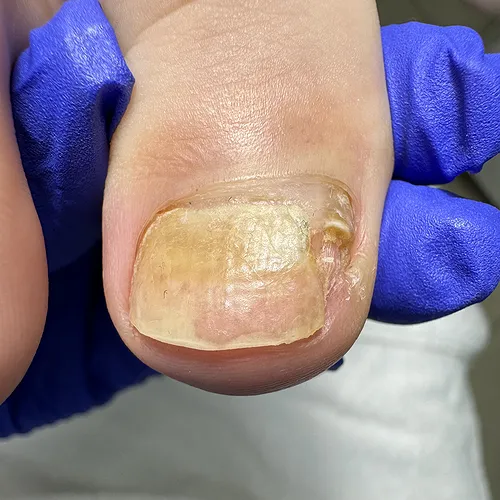 Onycholysis toenail picture Onycholysis toenail image
