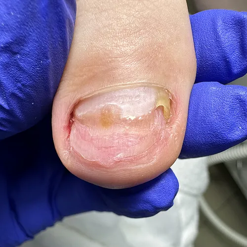 Treatment for onycholysis treatment for onycholysis toenail