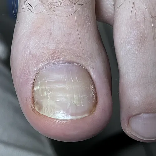 Onycholysis toenail before treatment onycholysis toenail