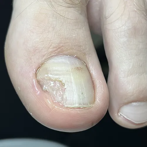 Onycholysis toenail after treatment Onycholysis toenail treatment