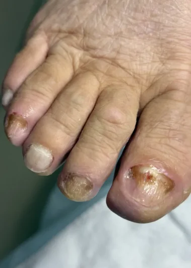 Podological pedicure