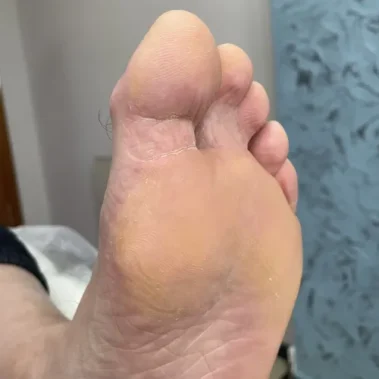 Skin fungus foot treatment