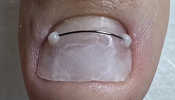 Titanium nail thread correction in Kyiv at Daria Kuzmenko Podology Center Titanium wire nail correction system