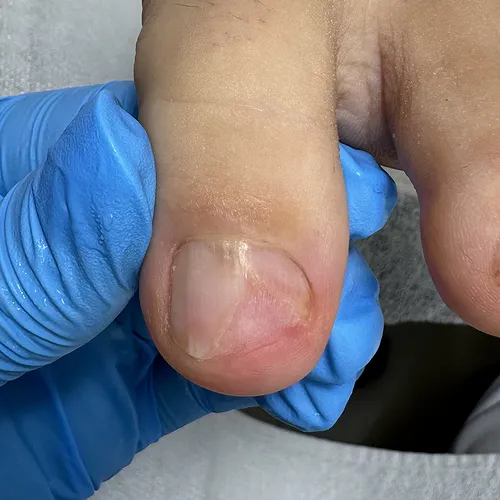 Toenail separation treatment Toenail separation after treatment