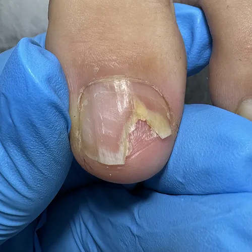 Toenail separation from nail bed toenail separation