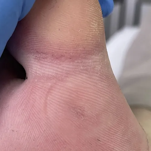 wart on foot removal