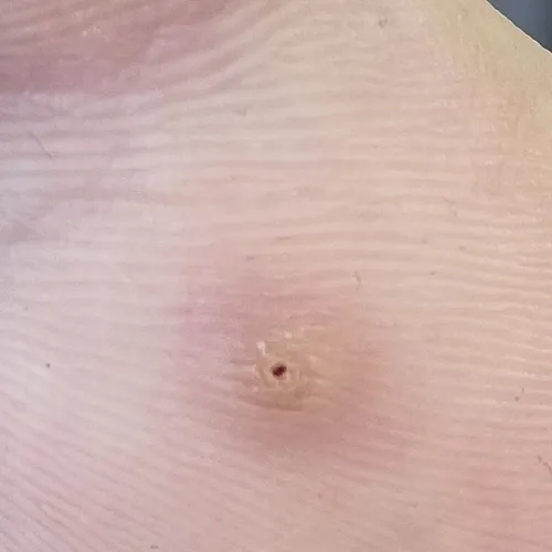 wart on foot